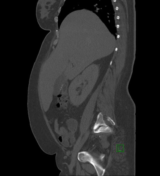 File:Chromophobe renal cell carcinoma (Radiopaedia 84239-99519 Sagittal bone window 74).jpg