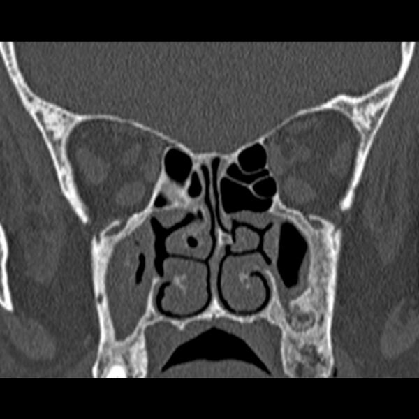File:Chronic maxillary sinusitis (Radiopaedia 27879-28116 Coronal bone window 30).jpg