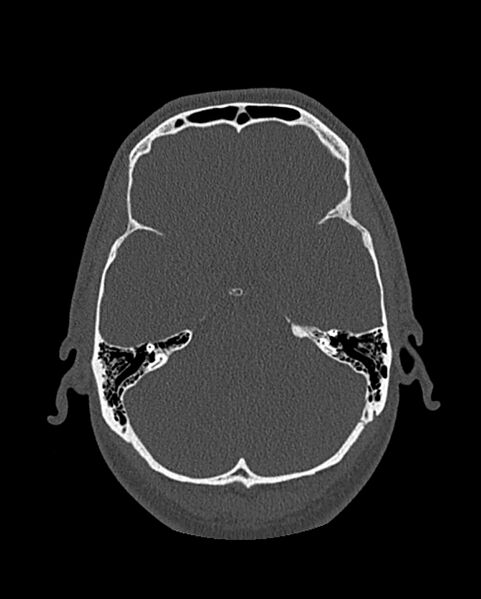File:Chronic maxillary sinusitis caused by a foreign body (Radiopaedia 58521-65676 Axial bone window 278).jpg