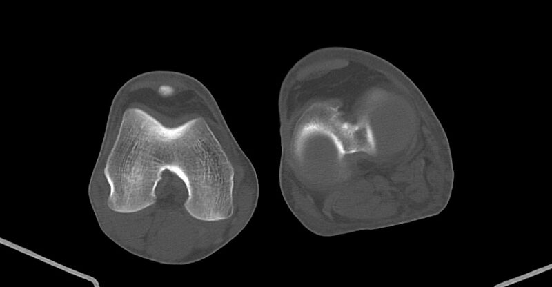 File:Chronic osteomyelitis (with sequestrum) (Radiopaedia 74813-85822 Axial non-contrast 190).jpg
