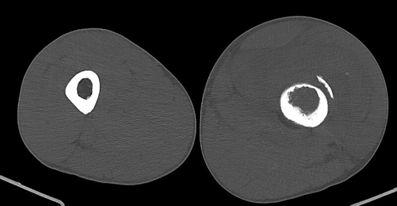 File:Chronic osteomyelitis (with sequestrum) (Radiopaedia 74813-85822 Axial non-contrast 95).jpg