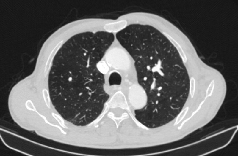 File:Chronic pulmonary embolism (Radiopaedia 91241-108843 Axial lung window 28).jpg