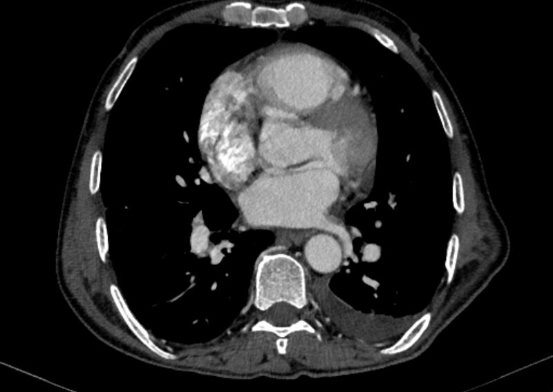 File:Chronic pulmonary embolism with bubbly consolidation (Radiopaedia 91248-108850 C+ arterial phase 90).jpg