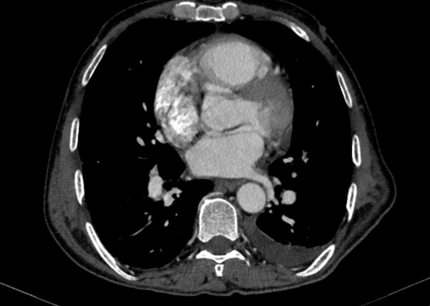 Chronic pulmonary embolism with bubbly consolidation (Radiopaedia 91248-108850 C+ arterial phase 90).jpg