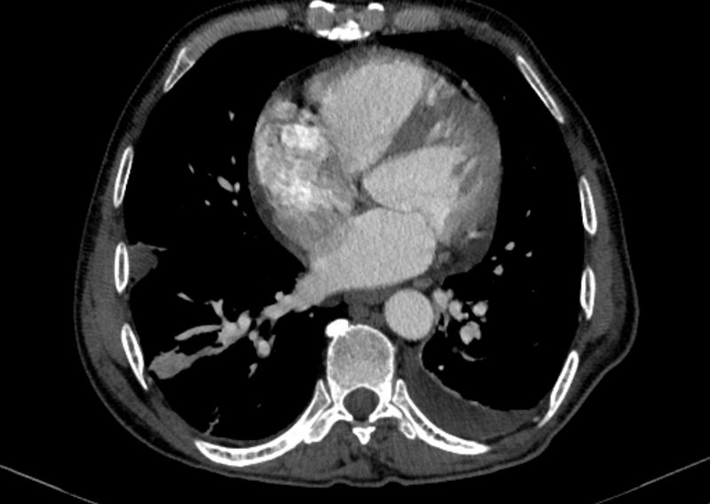 File:Chronic pulmonary embolism with bubbly consolidation (Radiopaedia 91248-108850 C+ arterial phase 99).jpg