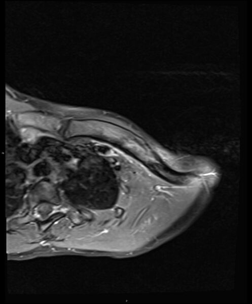 File:Chronic reactive multifocal osteomyelitis (CRMO) - clavicle (Radiopaedia 56406-63114 Axial T1 C+ fat sat 8).jpg