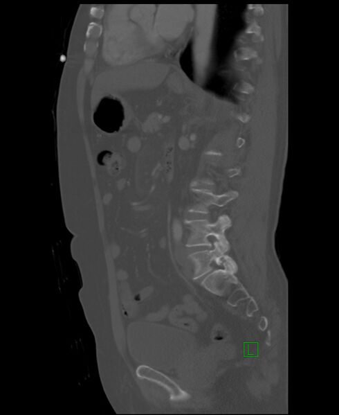File:Clear cell renal cell carcinoma (Radiopaedia 85006-100539 Sagittal bone window 26).jpg