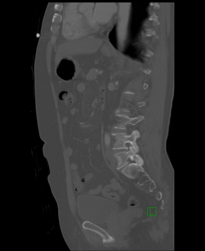 Clear cell renal cell carcinoma (Radiopaedia 85006-100539 Sagittal bone window 26).jpg