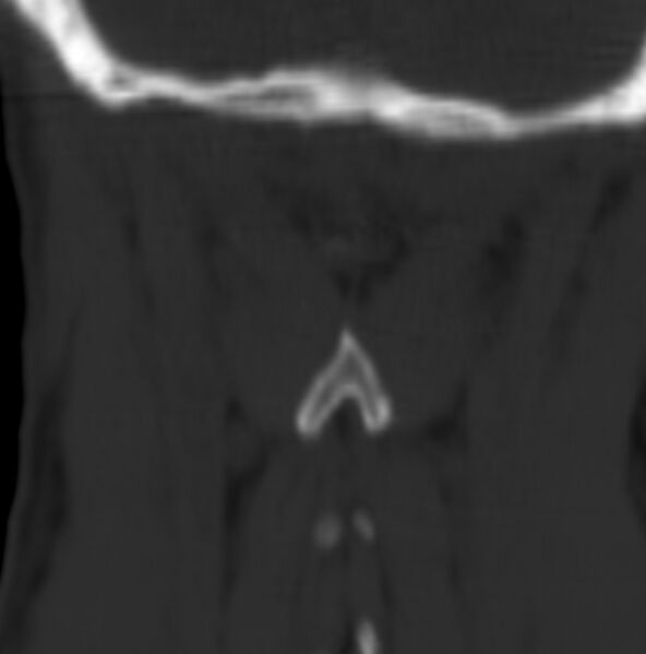 File:Cleft of the posterior arch of C1 mimicking fracture (Radiopaedia 40201-42721 Coronal bone window 1).jpg