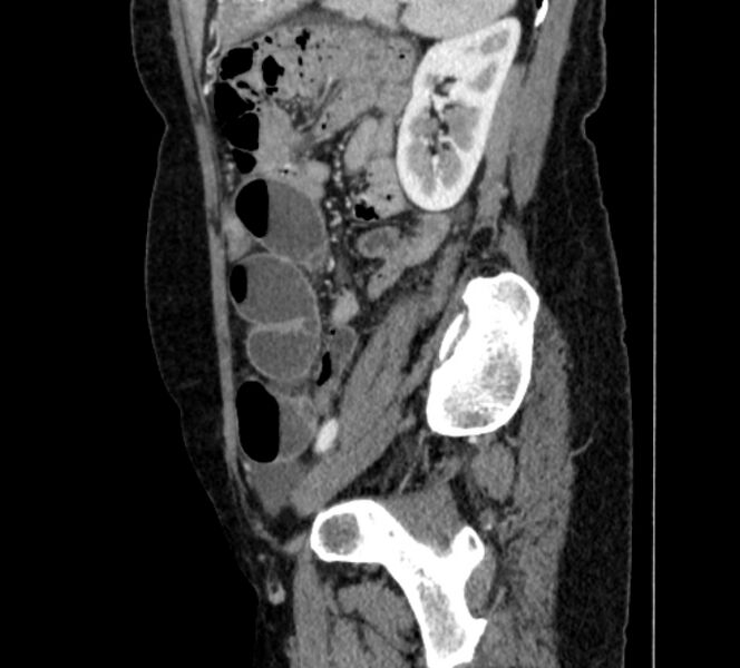 File:Closed loop small bowel obstruction (Radiopaedia 71211-81508 C 120).jpg