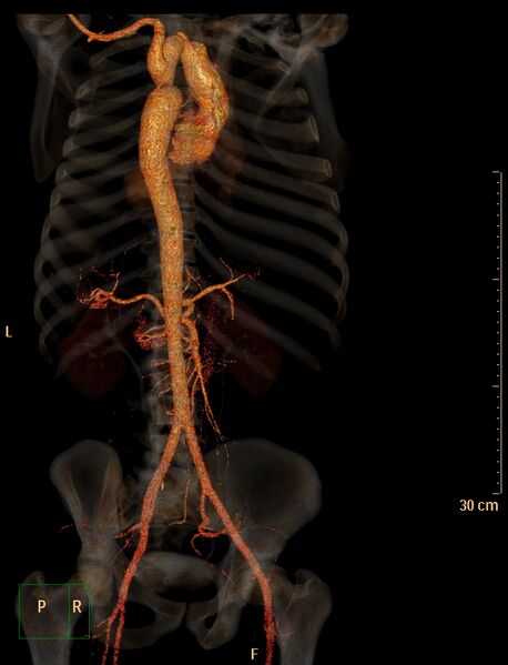 File:Coarctation of the aorta (Radiopaedia 49784-55050 3D VRT 11).jpg
