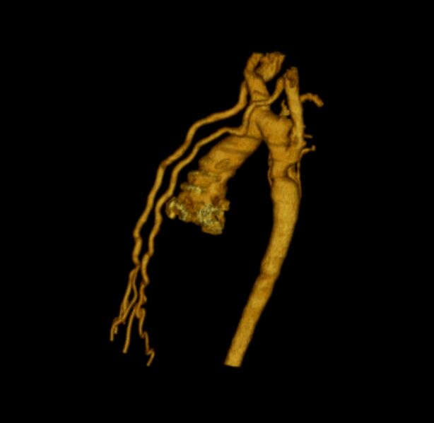 File:Coarctation of the aorta (Radiopaedia 6279-7684 3D rotation 1).jpg