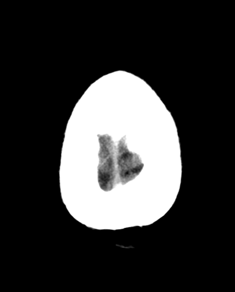 File:Colloid cyst of the third ventricle (Radiopaedia 86571-102661 Axial non-contrast 30).png