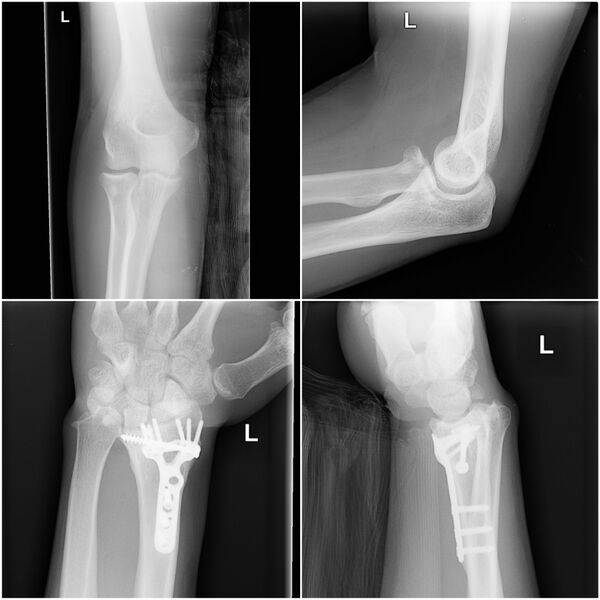 File:Essex-Lopresti fracture-dislocation (Radiopaedia 35251-36809 None 1).jpg