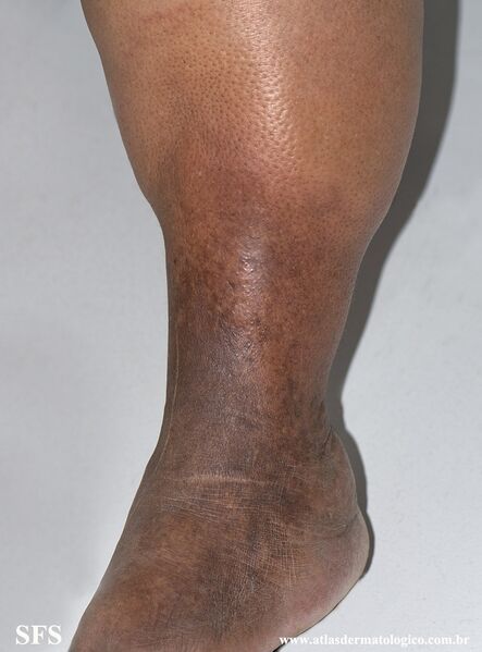 File:Lipodermatosclerosis (Dermatology Atlas 5).jpg
