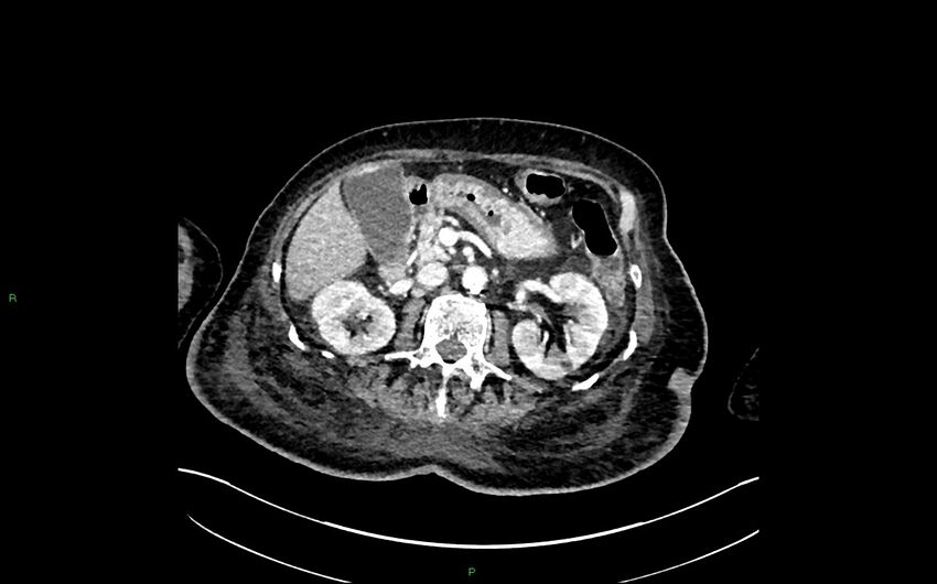 Neo-terminal ileal stricture (Crohn disease) (Radiopaedia 33790-34948 A 161).jpg