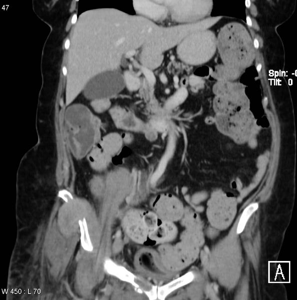 File:Nerve sheath tumor - malignant - sacrum (Radiopaedia 5219-6987 B 2).jpg