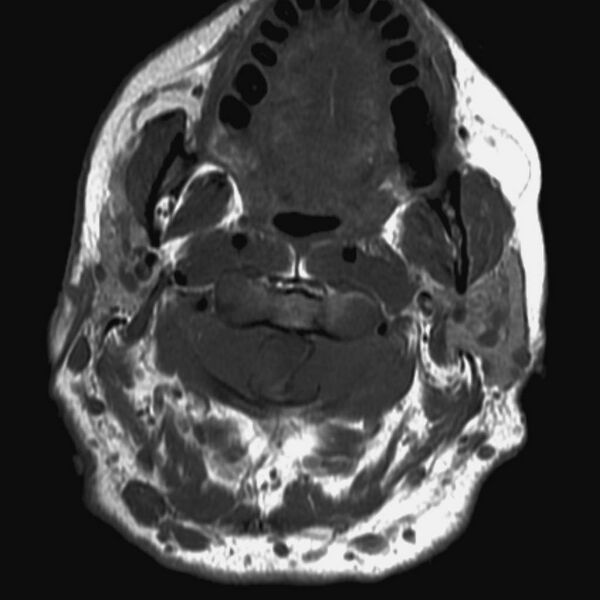 File:Neurofibromatosis type 1 (Radiopaedia 9159-9859 Axial T1 1).jpg