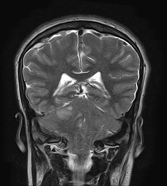 File:Neurofibromatosis type 2 (Radiopaedia 66211-75401 Coronal T2 16).jpg