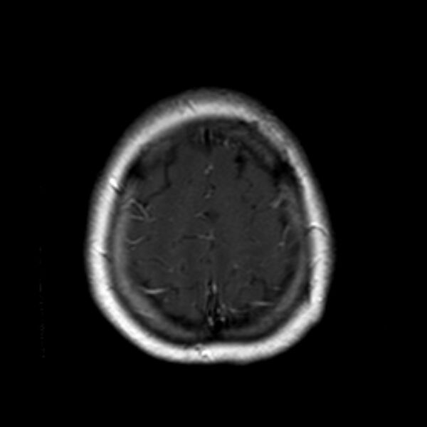 File:Neurofibromatosis type 2 (Radiopaedia 67470-76871 Axial T1 C+ 21).jpg