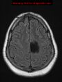 Neuroglial cyst (Radiopaedia 10713-11184 Axial FLAIR 5).jpg