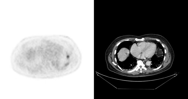 File:Non-Hodgkin lymphoma involving seminal vesicles with development of interstitial pneumonitis during Rituximab therapy (Radiopaedia 32703-33675 axial PET CT 43).jpg