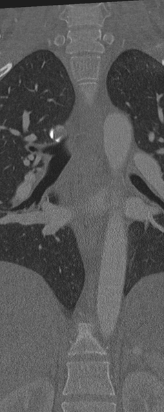 File:Normal CT thoracic spine (Radiopaedia 40181-42688 Coronal bone window 22).png