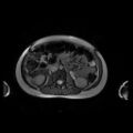 Normal MRI abdomen in pregnancy (Radiopaedia 88001-104541 Axial Gradient Echo 25).jpg
