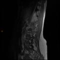 Normal spine MRI (Radiopaedia 77323-89408 Sagittal T1 11).jpg