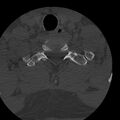 Occipital condyle fracture (Radiopaedia 31755-32691 Axial bone window 72).jpg