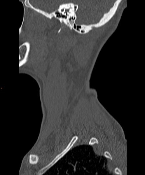 File:Occipital condyle fracture (Radiopaedia 61165-69056 Sagittal bone window 3).jpg