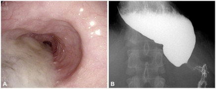 a) Dilatation in the middle esophagus b) achalasia with esophageal dilatation