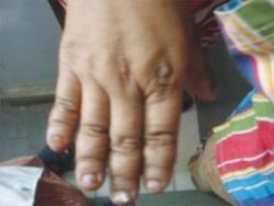 Hands of the mother also affected by cleidocranial dysplasia, showing brachydactyly