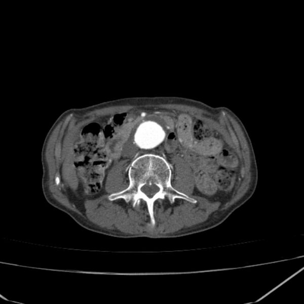 File:Abdominal aortic aneurysm (Radiopaedia 23703-23856 Axial C+ arterial phase 40).jpg