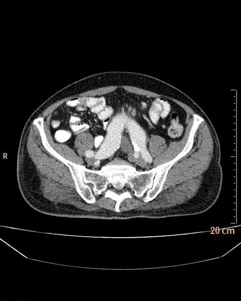 File:Abdominal aortic aneurysm (Radiopaedia 25985-26121 Axial C+ arterial phase 32).jpg