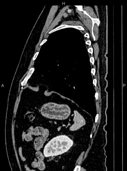 File:Abdominal aortic aneurysm (Radiopaedia 83094-97462 Sagittal renal cortical phase 98).jpg