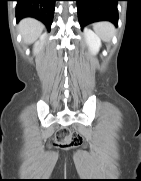 File:Abdominal desmoid tumor (Radiopaedia 41007-43740 Coronal C+ portal venous phase 34).png
