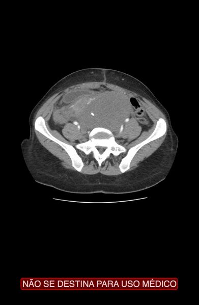File:Abdominal desmoid tumor (Radiopaedia 44024-47540 Axial C+ arterial phase 29).jpg
