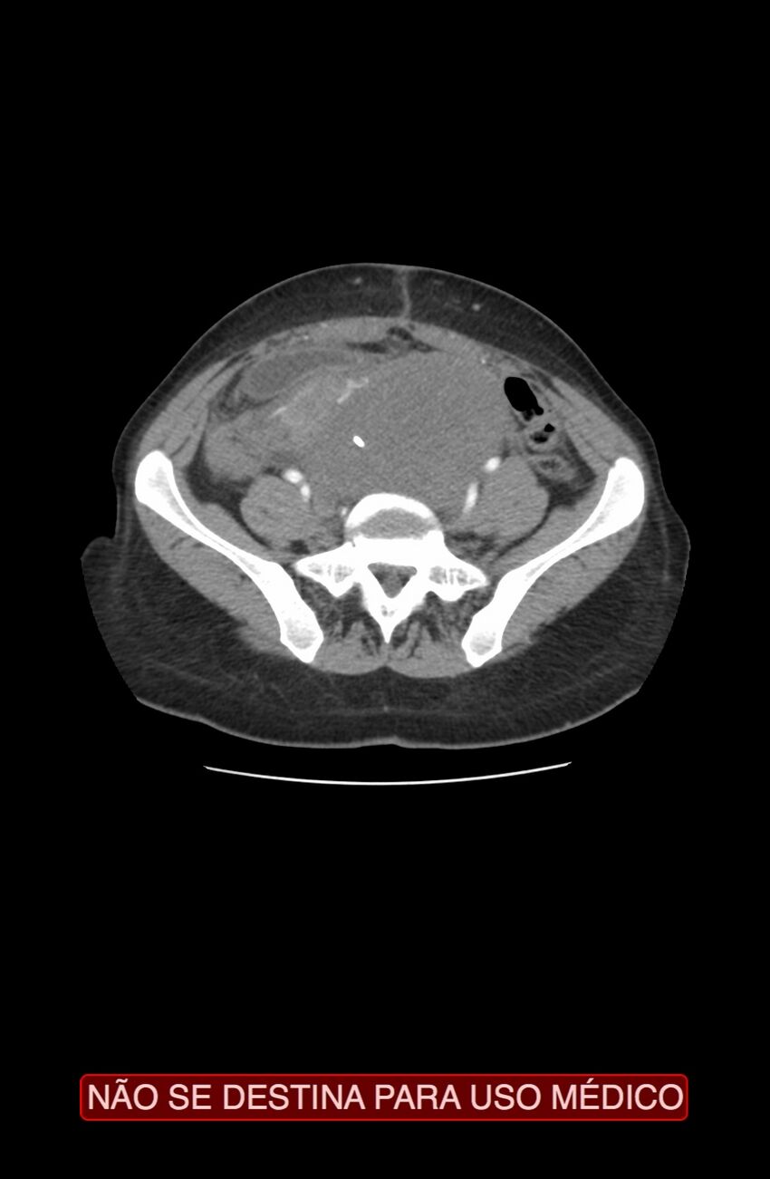 Abdominal desmoid tumor (Radiopaedia 44024-47540 Axial C+ arterial phase 29).jpg