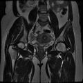 Abdominal wall endometriosis (Radiopaedia 83702-98847 Coronal T2 9).jpg