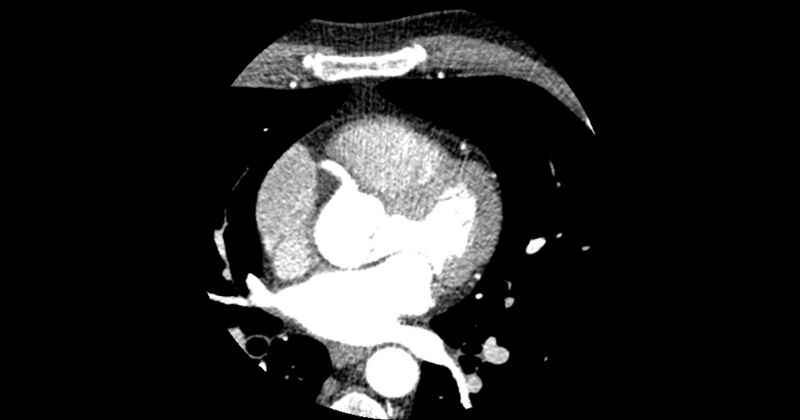 File:Aberrant left main coronary artery (ALMCA) arising from the right sinus with interarterial course (Radiopaedia 63251-71814 Axial C+ arterial phase 77).JPG