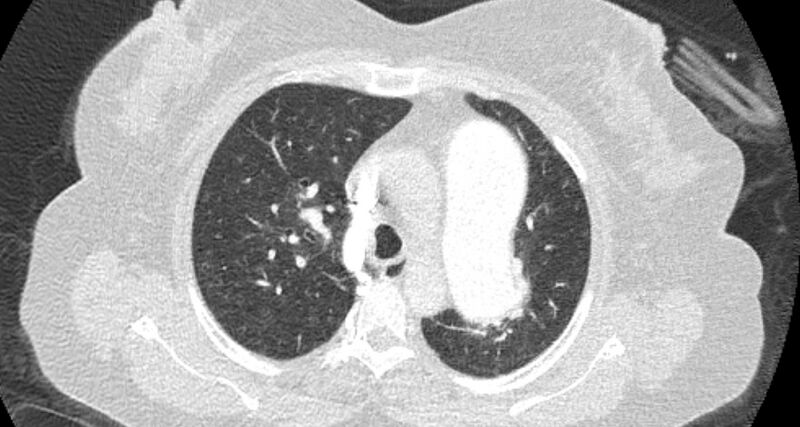 File:Accessory right inferior hepatic vein (Radiopaedia 65245-74259 Axial lung window 18).jpg