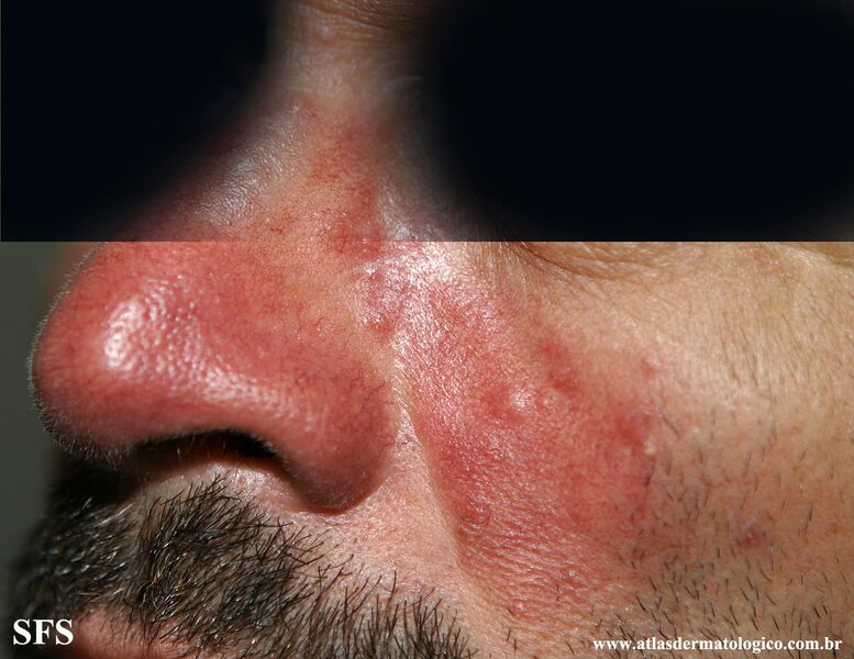 File:Acne Rosacea (Dermatology Atlas 26).jpg