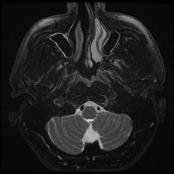 File:Acoustic schwannoma - intracanalicular (Radiopaedia 37247-39024 Axial T2 fat sat 1).jpg