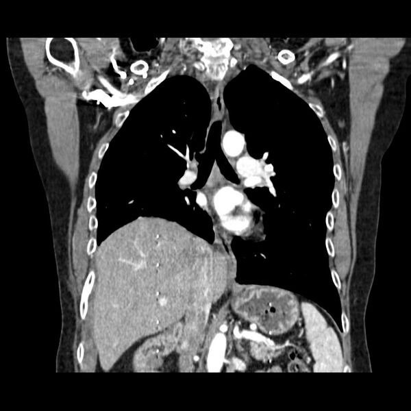 File:Acquired adrenal hyperplasia - due to thymic carcinoid tumor (Radiopaedia 21269-21184 C 2).jpg