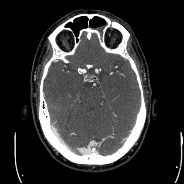 File:Acute A3 occlusion with ACA ischemic penumbra (CT perfusion) (Radiopaedia 72036-82527 Axial C+ arterial phase thins 114).jpg