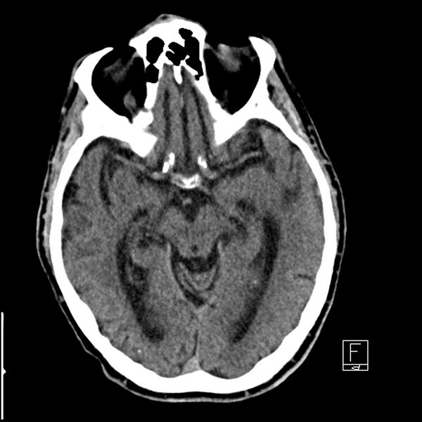 File:Acute ICA ischemic penumbra due to high-grade CCA stenosis (CT perfusion) (Radiopaedia 72038-82529 Axial non-contrast 19).jpg
