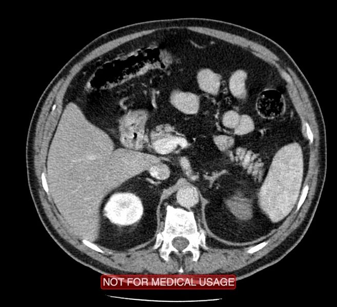 File:Acute aortic dissection - Stanford type A (Radiopaedia 40661-43285 Axial C+ portal venous phase 85).jpg