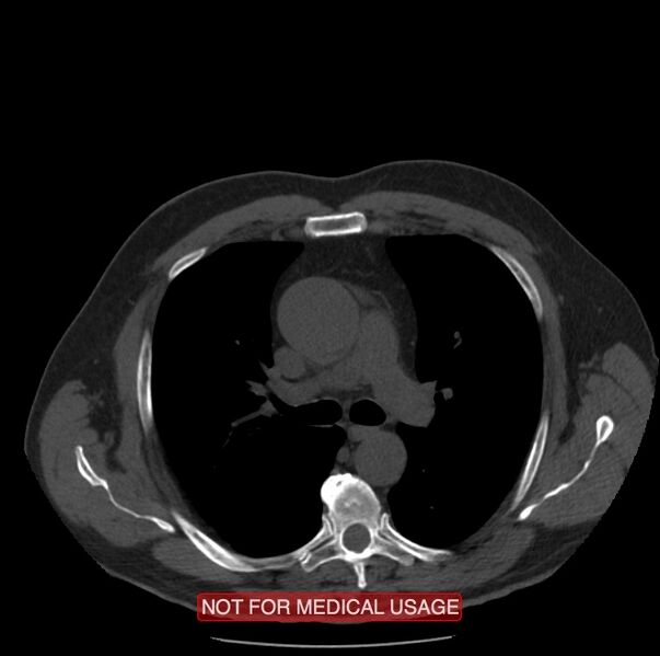 File:Acute aortic dissection - Stanford type A (Radiopaedia 40661-43285 Axial non-contrast 18).jpg