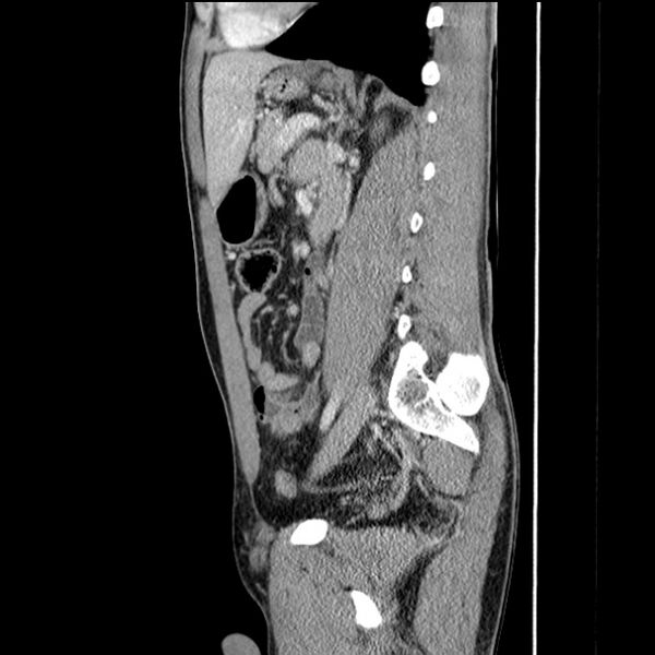 File:Acute appendicitis (Radiopaedia 27049-27227 Sagittal C+ portal venous phase 50).jpg
